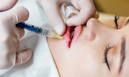 One Full Syringe of Restylane Kysse for Lips - Derma Med Spa - Frisco