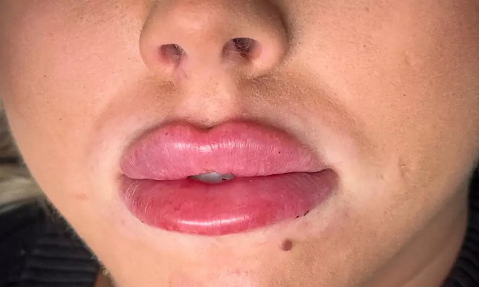 Enhance Your Natural Beauty with Dermal Filler Treatments