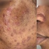 Image 4: One, Three, or Five Laser Skin Resurfacing Treatments