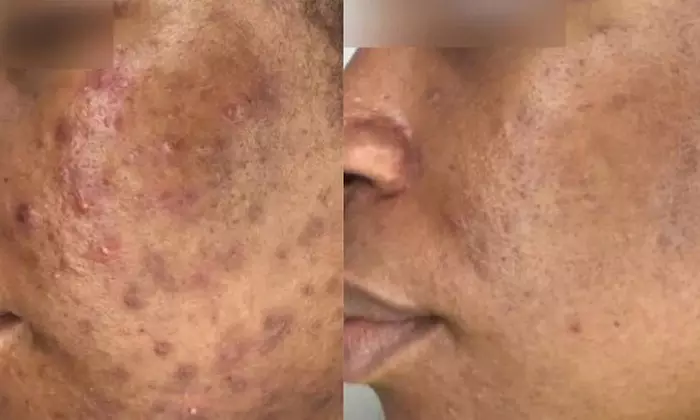 One, Three, or Five Laser Skin Resurfacing Treatments