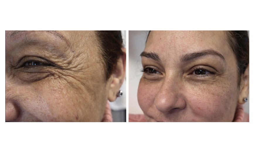 Image 3: Enhance Yourself with 20, 40, or 60 Units of Botox