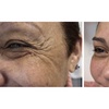 Image 3: Enhance Yourself with 20, 40, or 60 Units of Botox