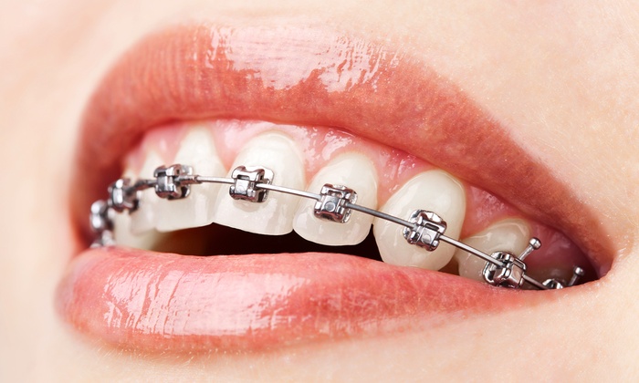 Royal Palm Orthodontics Up To 98 Off Royal Palm Beach Fl Groupon