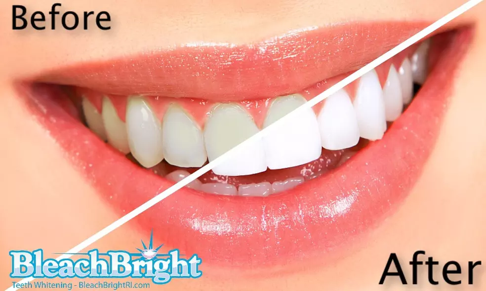 Up to 61% Off Teeth Whitening at BleachBright RI Inc - Primary Image