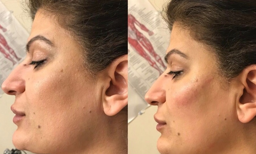 Image 6: Enhance Natural Beauty with Expert Dermal Filler Injections(0.5ml–2ml)