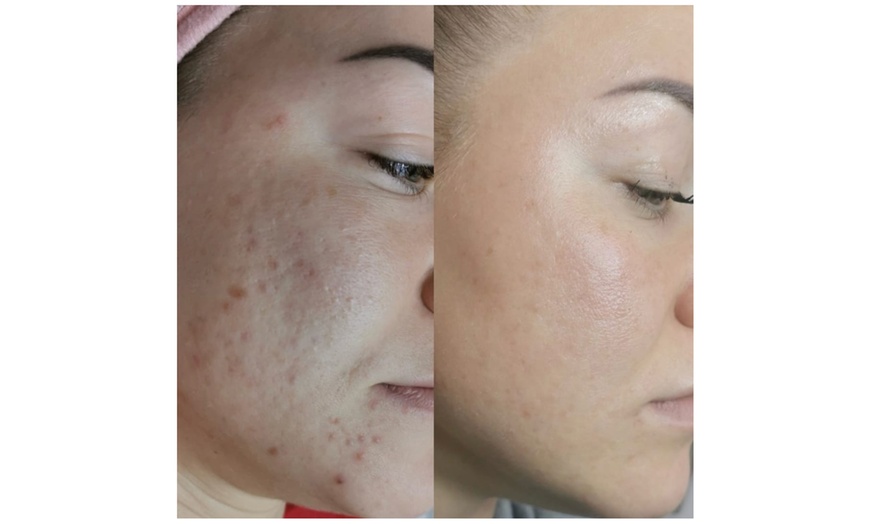 Image 3: Microneedling für Gesicht, opt. inkl. Hals oder SQT BiONeedling