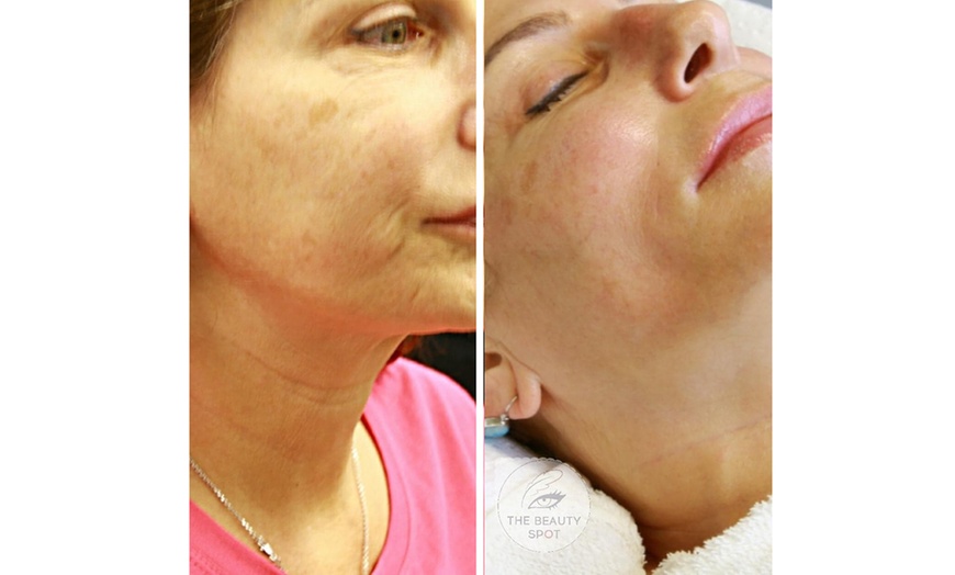 Image 3: Enhance Your Look with HIFU for Neck/Face or Both or Tattoo Eyeliner