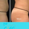 Image 3: Ultrasonic Cavitation Fat-Reduction Treatments for a Sleeker Look