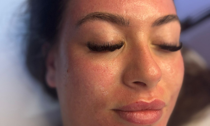 Image 1: One or Three Microneedling Sessions with Skin Booster