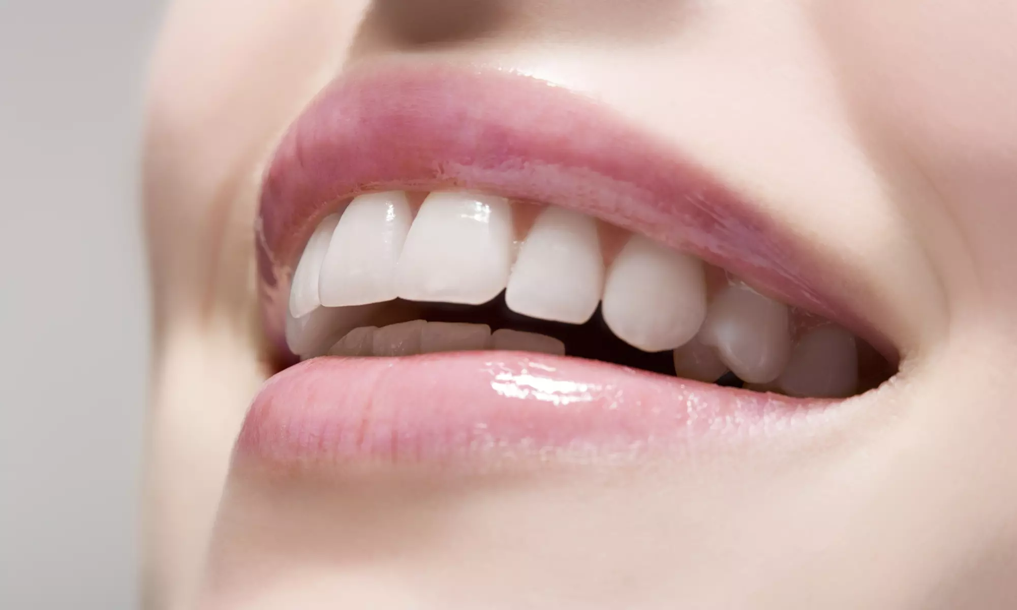 Veneers or Crowns with Exams, X-Rays, and  Home Bleaching Kit at Smile Center Of NY (Up to 42% Off) - Primary Image