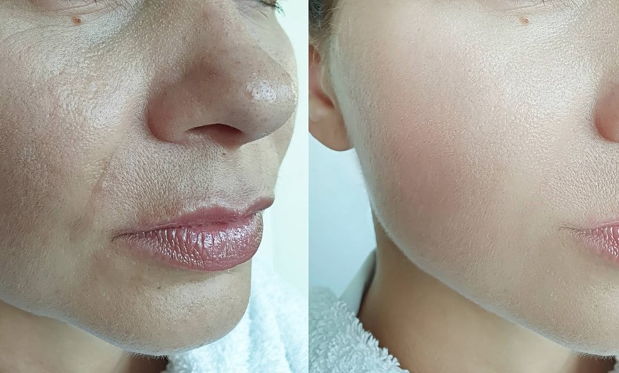 Image 6: Microneedling for Face & Neck or BB Glow Facial with Microneedling