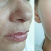 Image 6: Microneedling for Face & Neck or BB Glow Facial with Microneedling