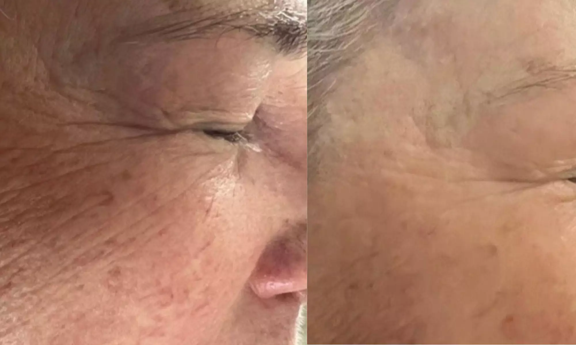 Radio Frequency Skin Tightening Treatment