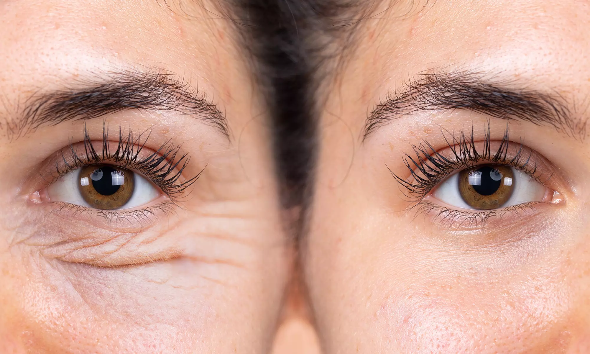 Reveal a Relaxed Look with 20, 40, or 60 Botox Units (Up to 44% Off) - Second Medium