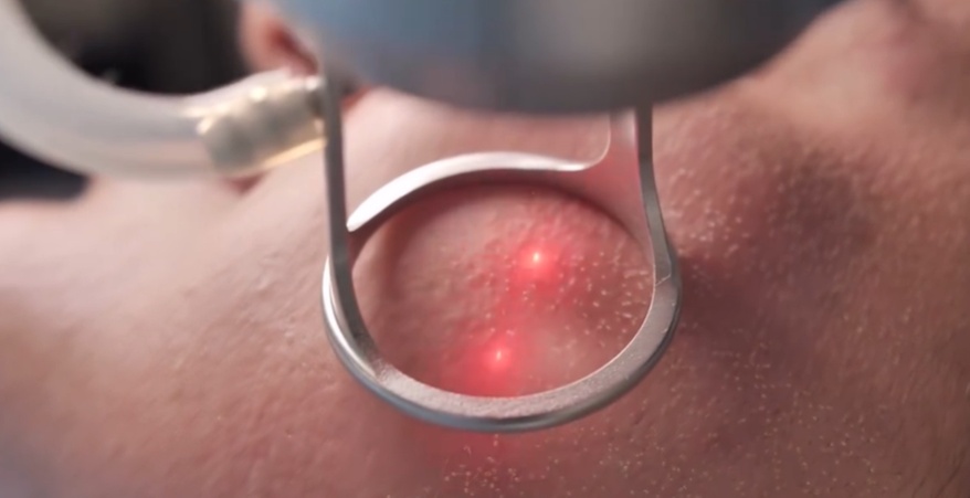 Up to 40% Off on Laser Skin Resurfacing at SculptME Med Spa