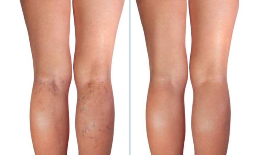 Image 5: Eliminación de varices o verrugas con tecnología avanzada 