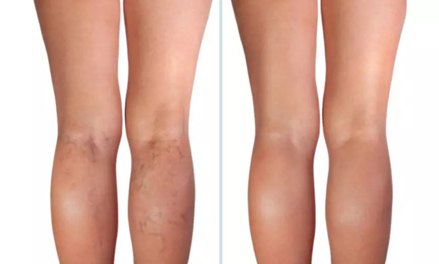 Image 5: Eliminación de varices o verrugas con tecnología avanzada 