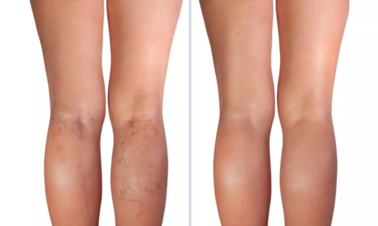 Eliminación de varices o verrugas con tecnología avanzada