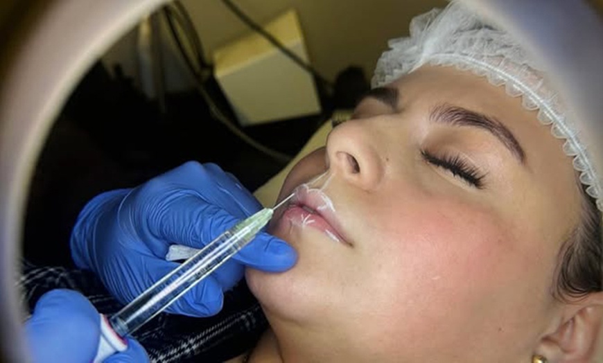 Image 3: Lip Flip or 20, 40 or 60 Units of Botox 