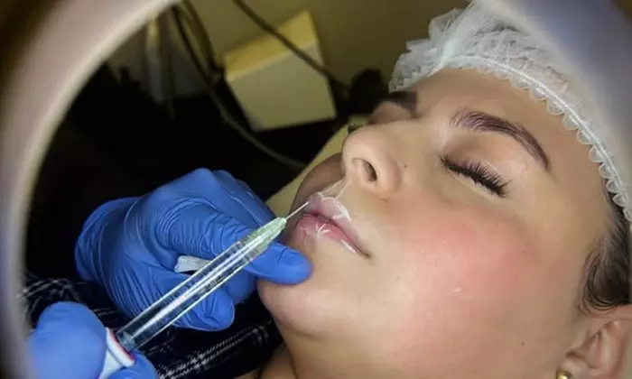 Lip Flip or 20, 40 or 60 Units of Botox