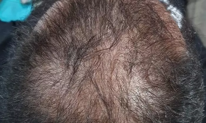 Scalp Micropigmentation