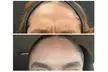 Turn Back Time with Xeomin or Jeuveau: 20, 40, or 60 Units at Abundant Aesthetics, Up to 30% Off - Second Medium