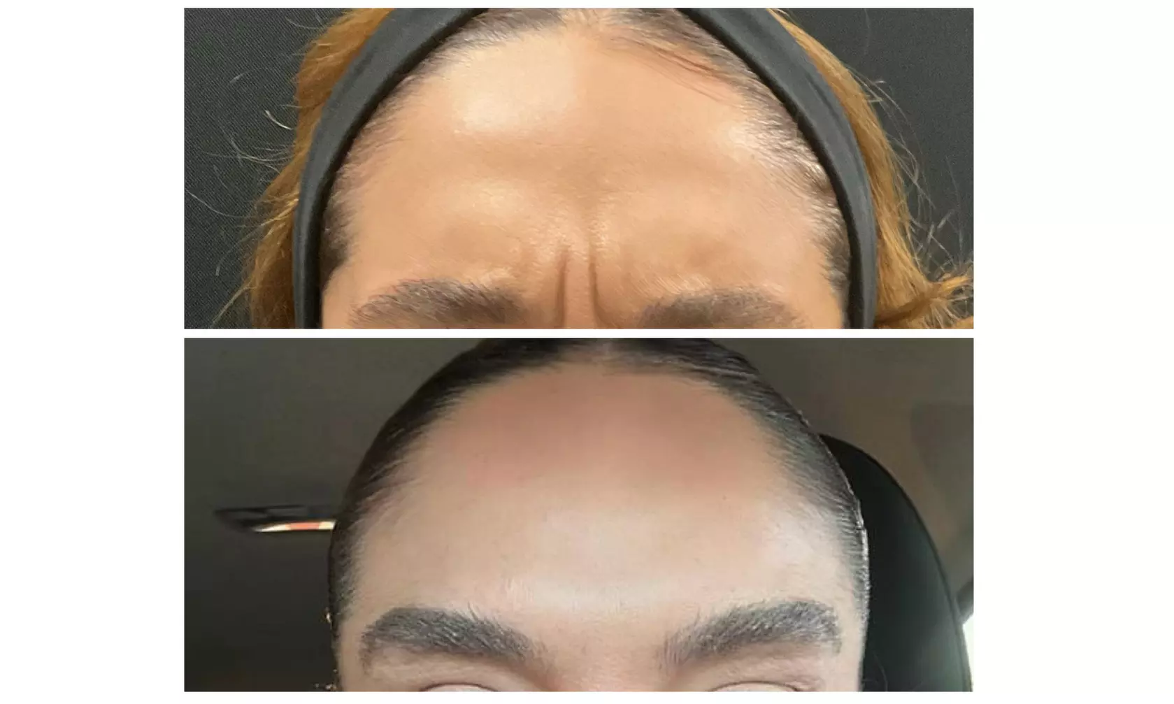 Glow Naturally w/ 20, 40, or 60 Units of Xeomin or Jeuveau