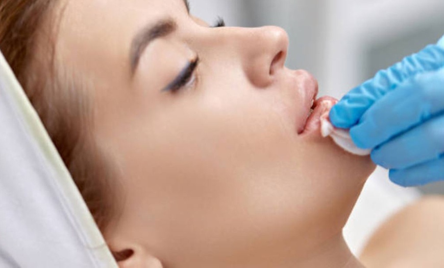 Image 15: Infiltración de 1 o 2 viales de tratamiento de relleno facial para 1