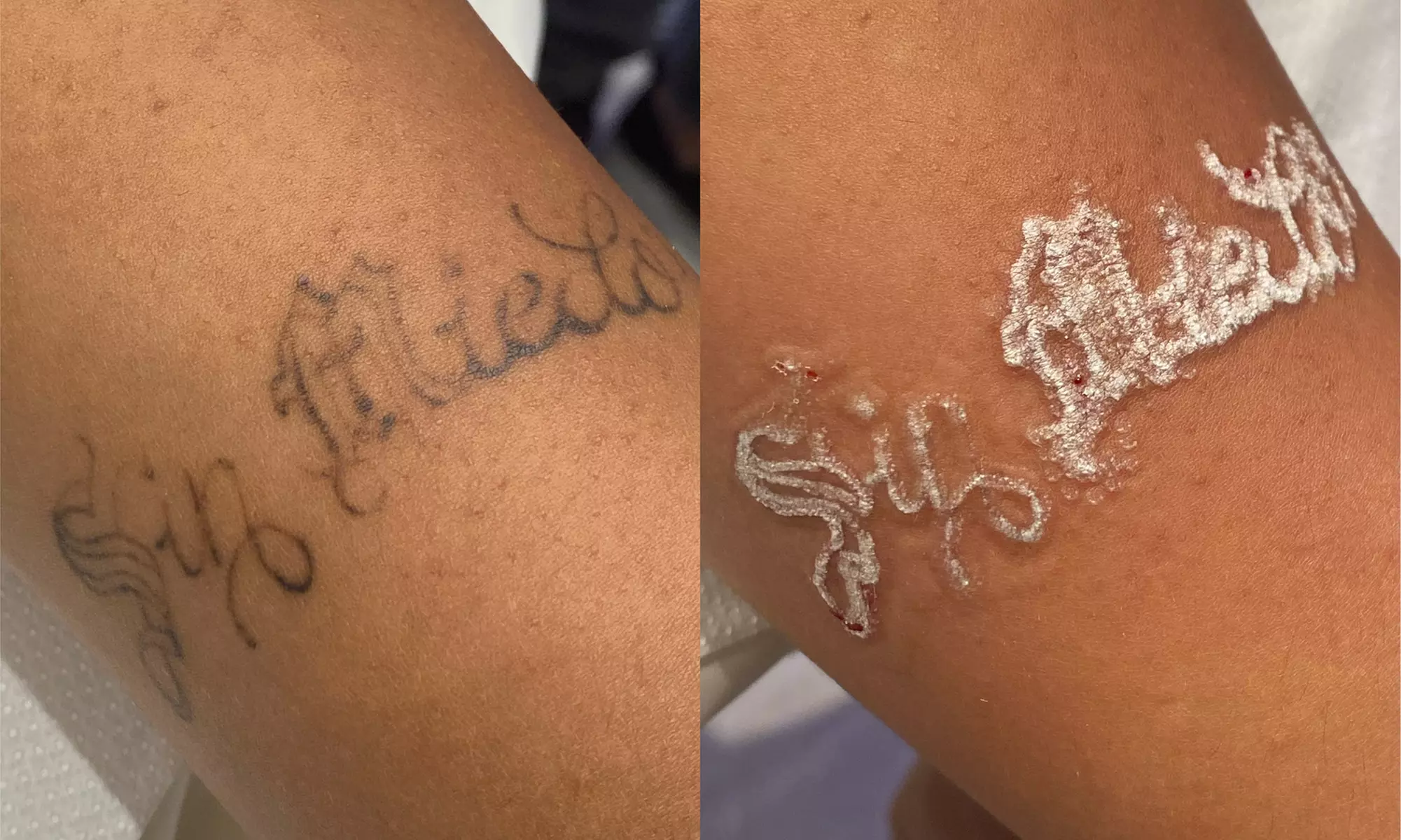 1 oder 2 x Laserbehandlung für das Entfernen von Permanent Make-up / Microblading für 1 Person (bis 37% sparen) - Second Medium