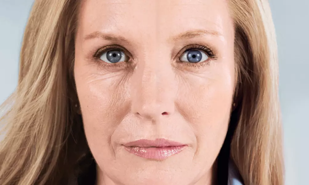 Refine with 2 or 4 Vials of Sculptra or Twelve Vials of Scupltra & Ha
