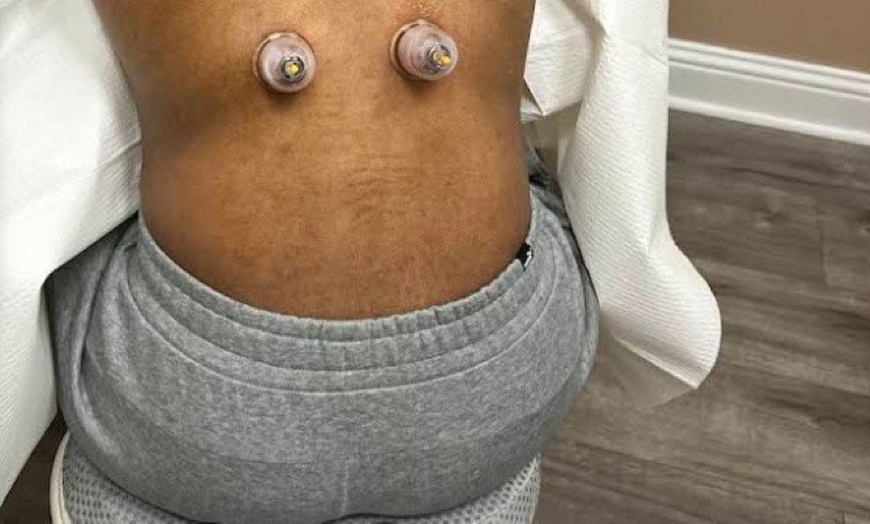 Image 6: 20-Minute 1, 3, or 5 Combination Cupping Sessions: (Wet, Dry & Moving)