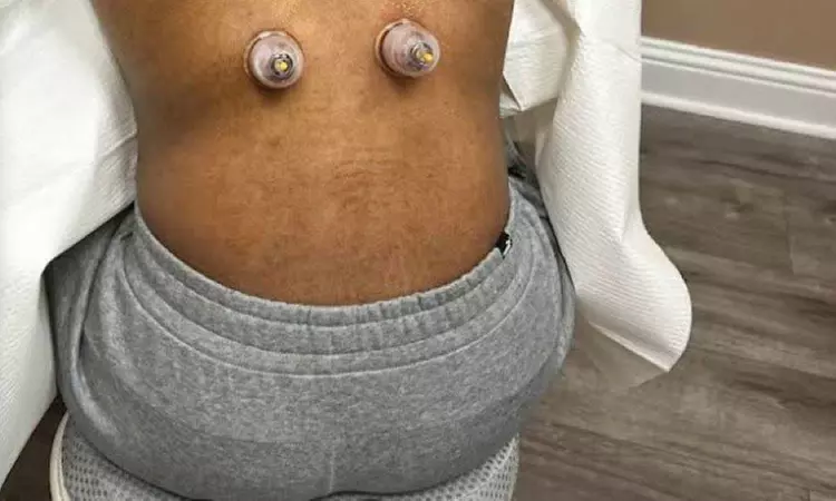 20-Minute 1, 3, or 5 Combination Cupping Sessions: (Wet, Dry & Moving)