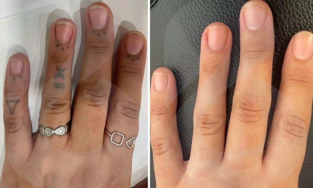 4 sesiones de eliminación de tatuajes con láser en zona pequeña