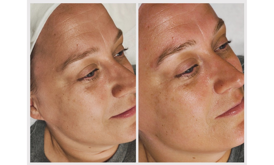 Image 4: Microdermabrasion or Microchanneling Facial for Rejuvenated Skin