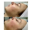 Image 5: Experience IPL Photofacial for Skin Renewal
