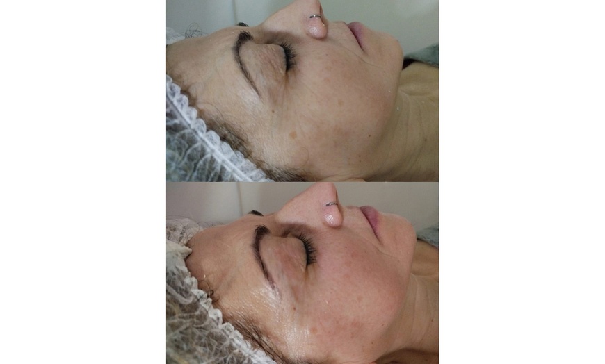 Image 6: 1 o 2 sesiones de radiofrecuencia facial o corporal Indiba