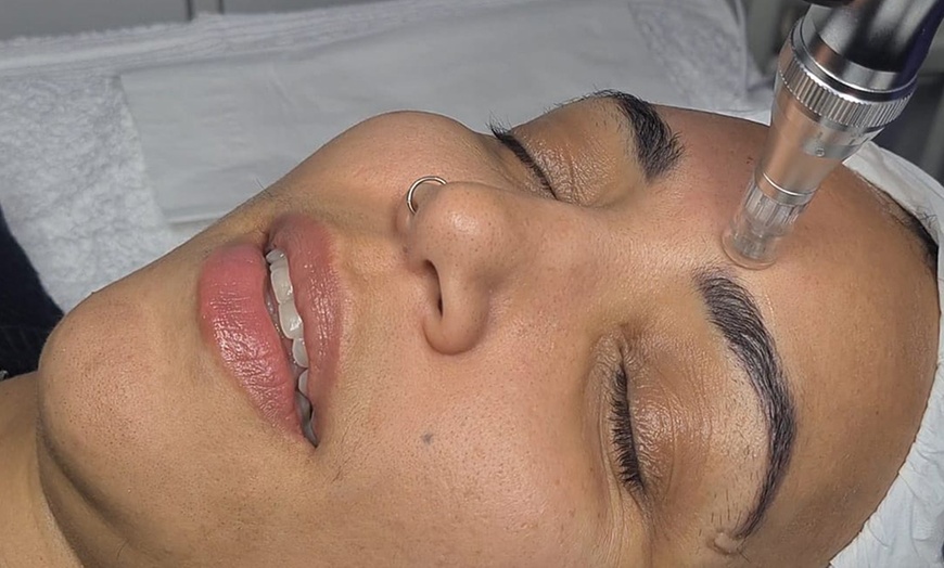 Image 6: One Microdermabrasion or Fill Up 360 Microneedling with LED Therapy!
