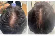 Up to 60% Off on Hair Restoration - Non-Surgical at Mar Essence - Second Medium