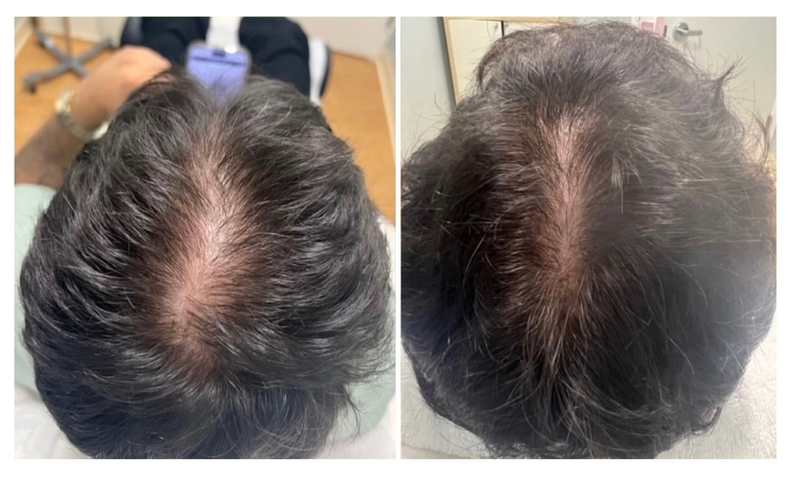 Image 2: Up to 70% Off on Hair Restoration - Non-Surgical at Mar Essence