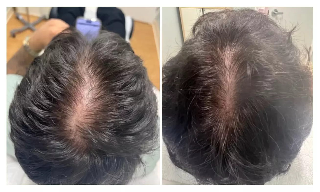 Transform Your Hair with One Single Session of TED Hair Restoration