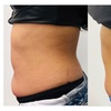 Image 5: Transform Your Look with Choice of Cavitation Options