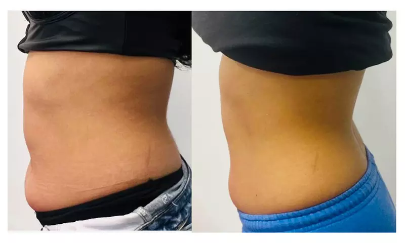 Transform Your Look with Choice of Cavitation Options at Silhouette Aesthetic - Up to 58% Off - Second Medium