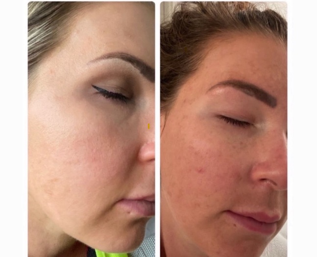Image 1: Experience Rejuvenation with Jessner Chemical Peels