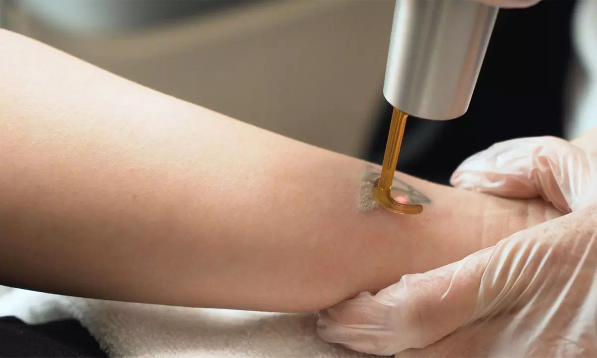 6 or 8 (30 Minutes) Laser Tattoo Removal Sessions for Smooth Skin
