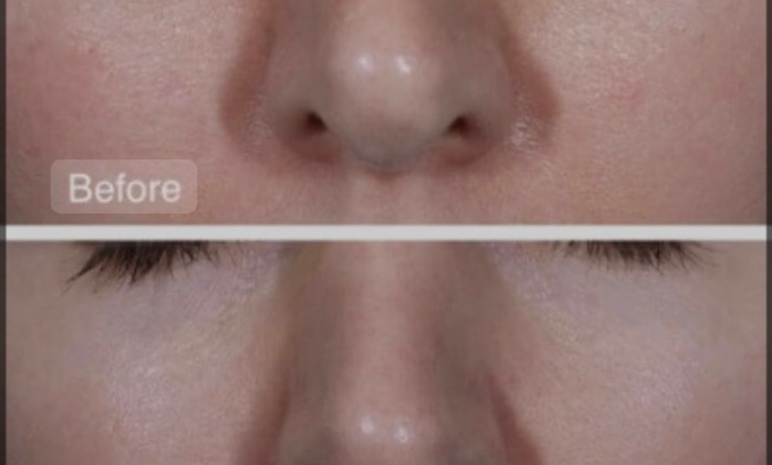 Image 3: Choice of Facial- Classic, Microdermabrasion, or More 