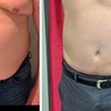 Image 1: Transform Your Body with Non-Invasive Laser Lipo Treatments!