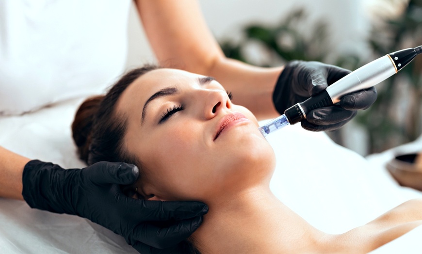 Image 2: 1 o 2 sesiones de limpieza facial con dispositivo de hidrolimpieza