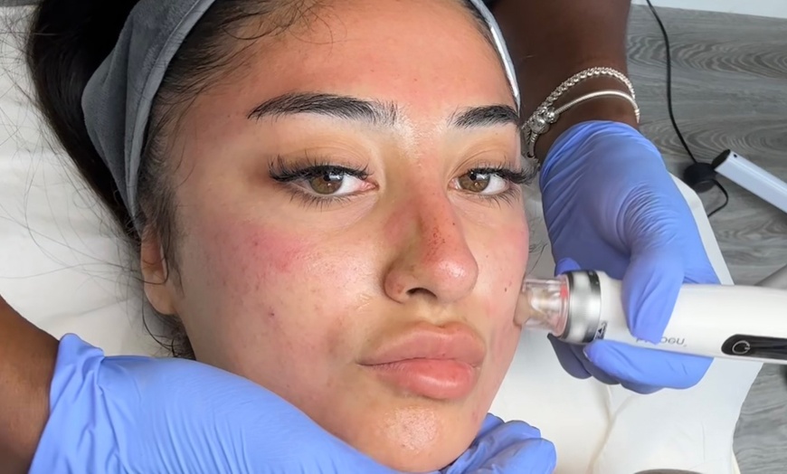 Image 5: Advanced Micro-needling w/ Luxury Hydrating Serums - Face and/or Neck