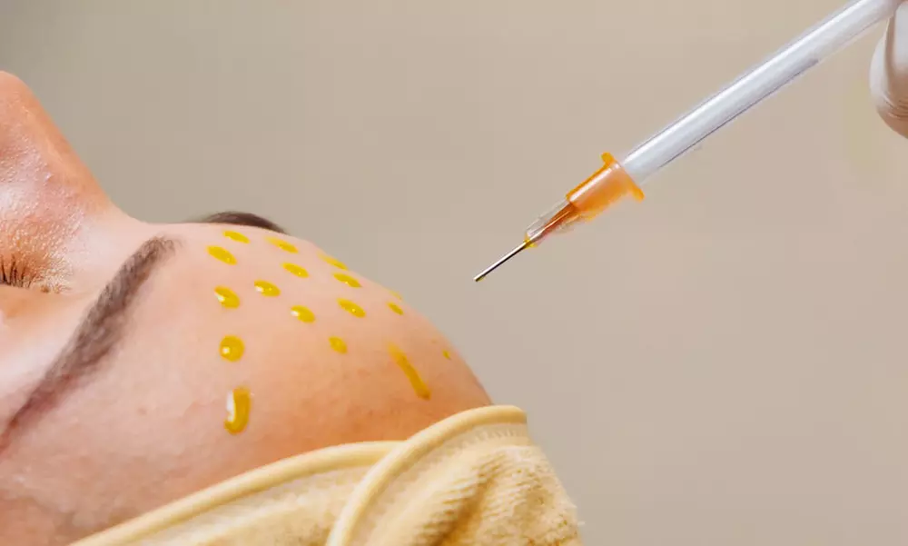 Revive Your Glow With Microneedling Or PRP Upgrade For A Powerful Skin Boost (Up to 46% Off) at Zeugma Spa - Primary Image