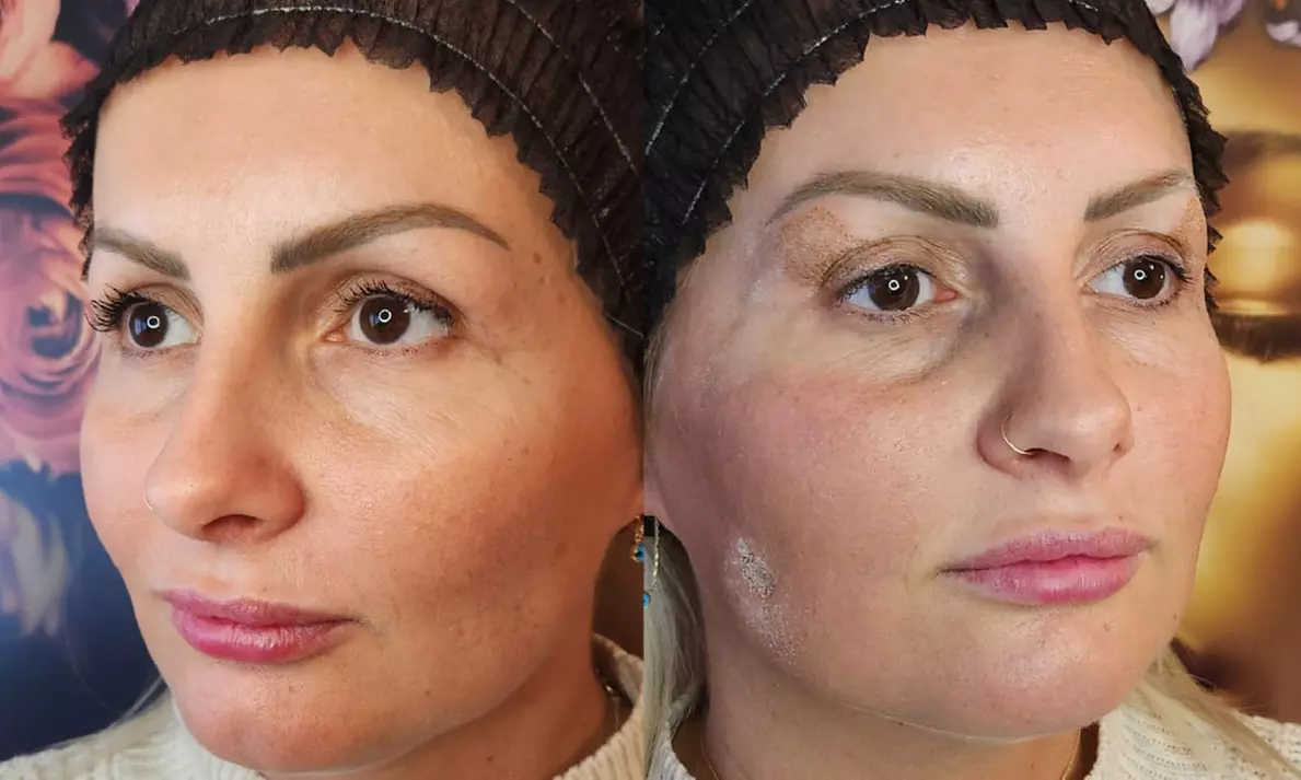 Plasmalift: Oberlidstraffung & Lifting mit Skin Corrector für 1 Person